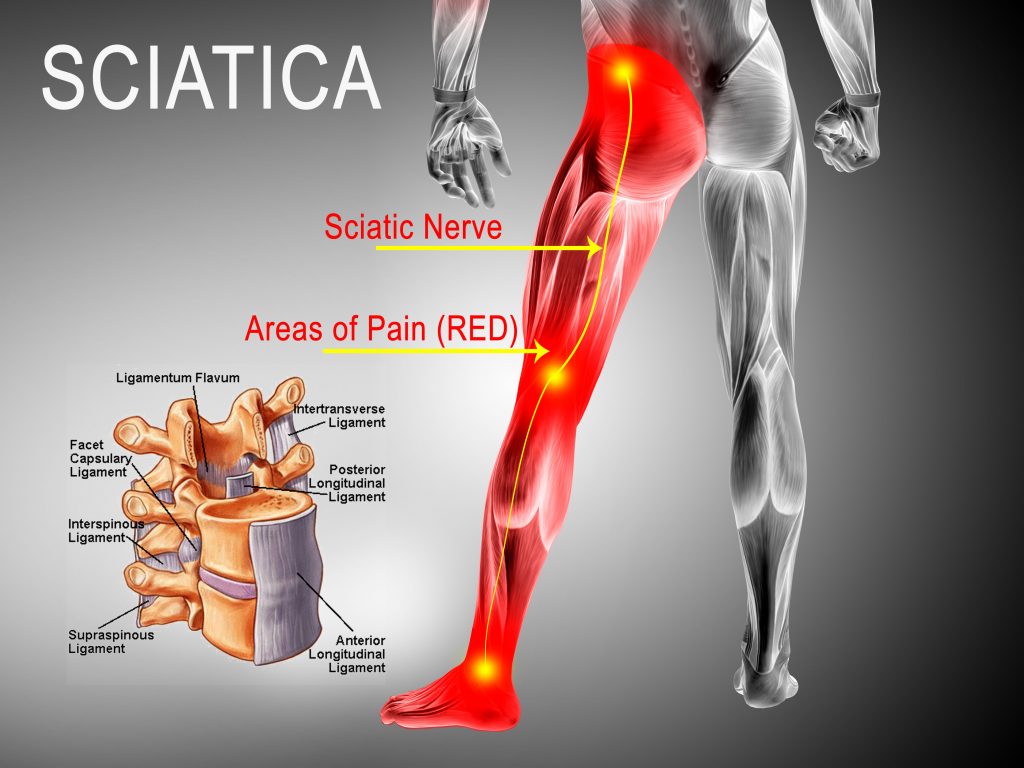 What Is Sciatica? - Legacy Clinic of Chiropractic