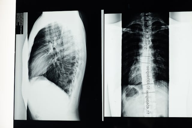 Scoliosis Treatment