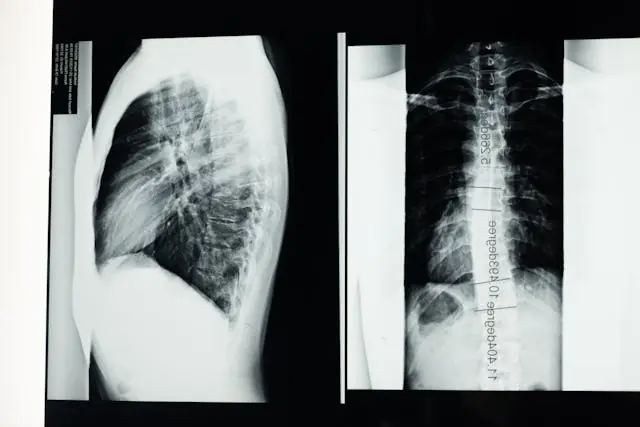 Scoliosis Treatment